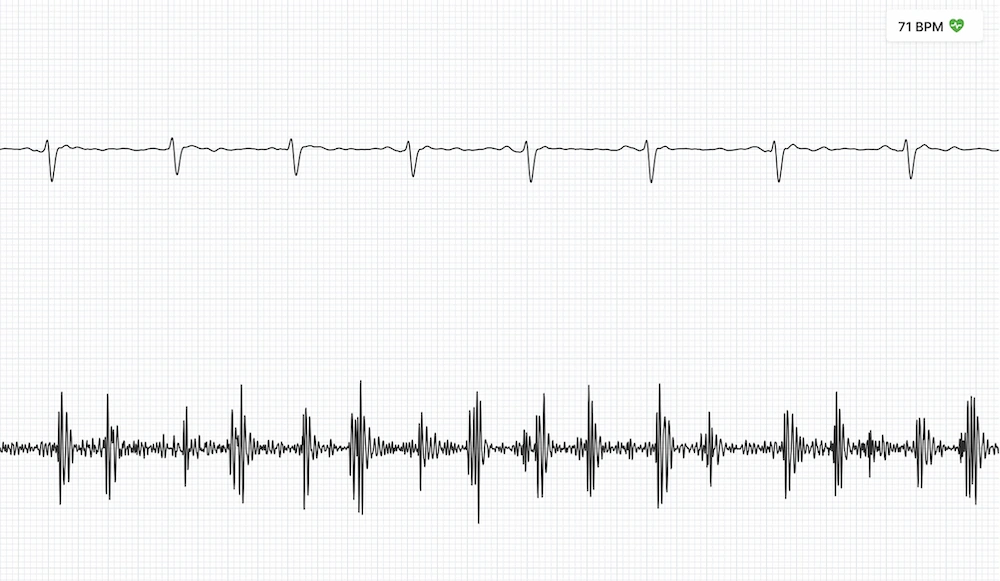 EKG rhythm strip with PCG phonocardiogram sound capture recording of heart sounds