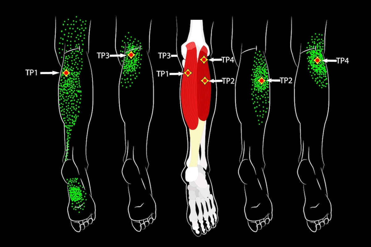 Trigger points in gastrocnemius muscle in leg schematic depiction