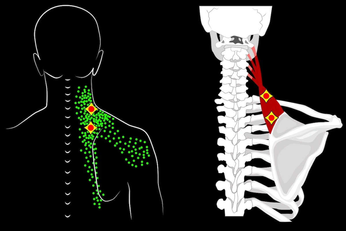 Trigger points in levator scapulae muscle attaching to shoulder blade schematic depiction