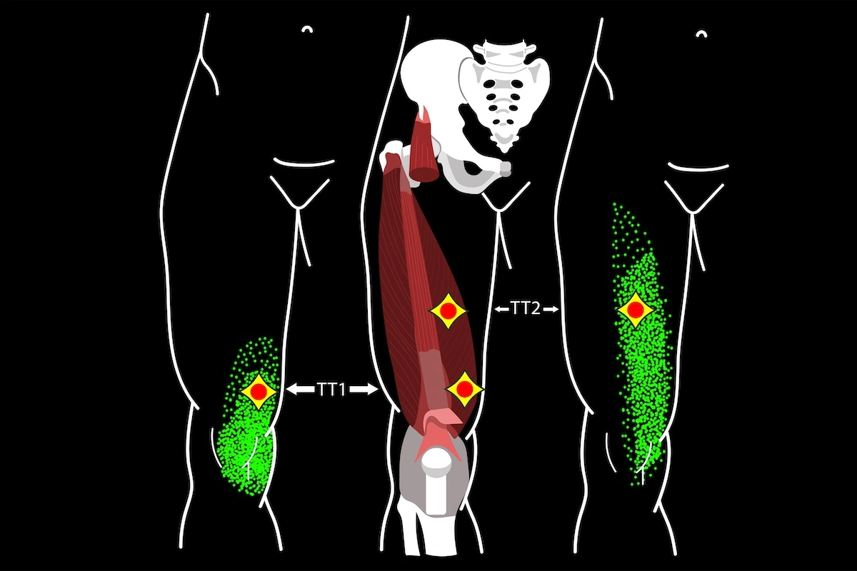 Trigger points in quadriceps muscle in thigh schematic depiction