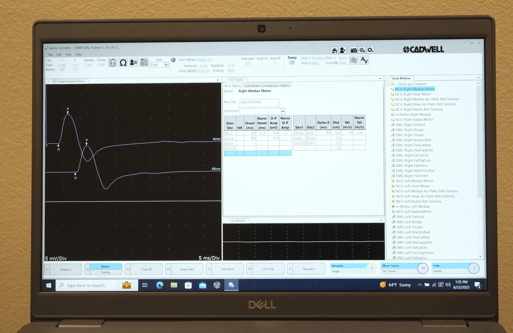 EMG screen monitor displaying median motor nerve conduction waveforms