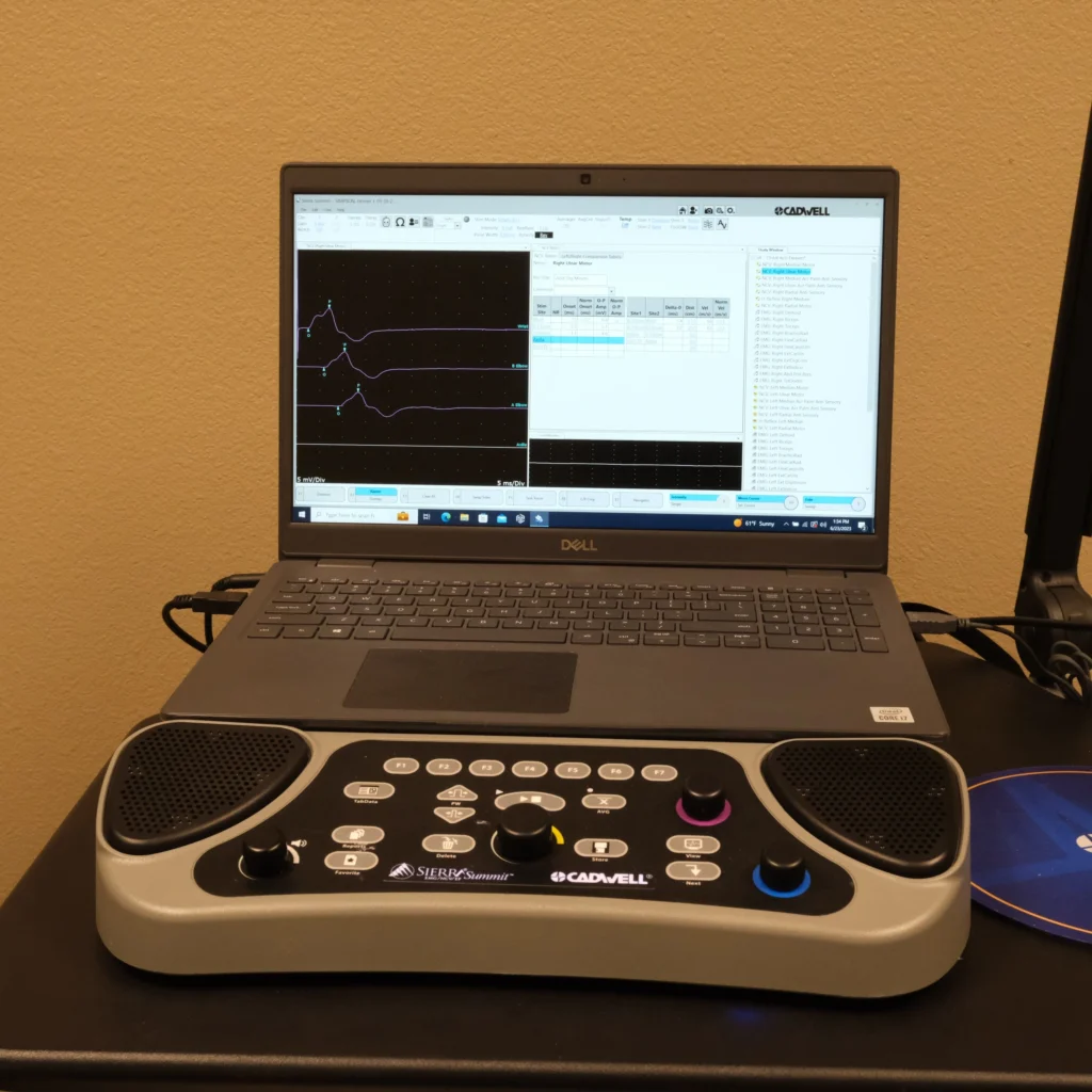 Cadwell Sierra Summit EMG machine screen monitor displaying ulnar motor nerve conduction waveforms