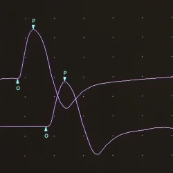 Median motor nerve conduction tracing showing close-up of waveform