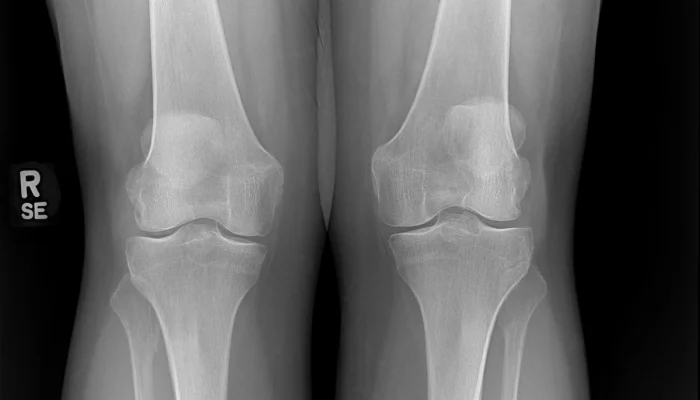 X-ray knees AP standing view