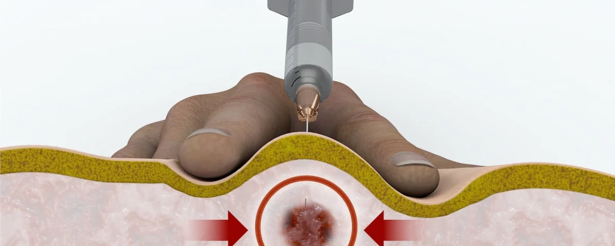 Trigger point injection schematic depiction